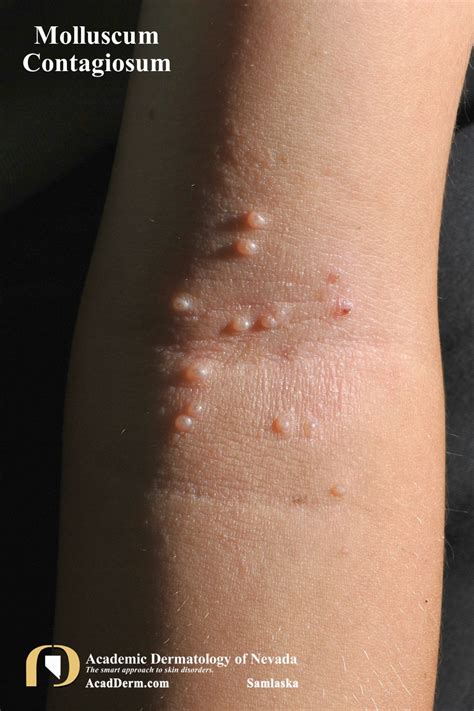 mollycum|Molluscum contagiosum .